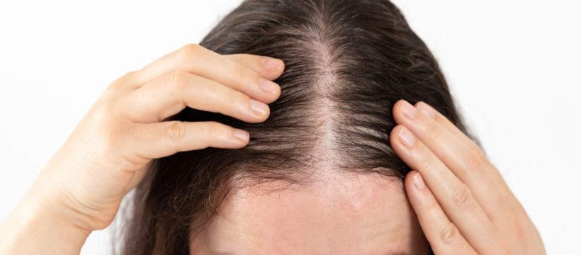 Female Hair Loss